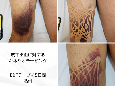キネシオテーピングのイメージ写真